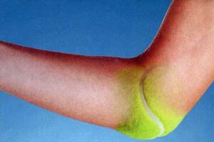Chữa đau khuỷu tay trong tennis elbow (Phần I)